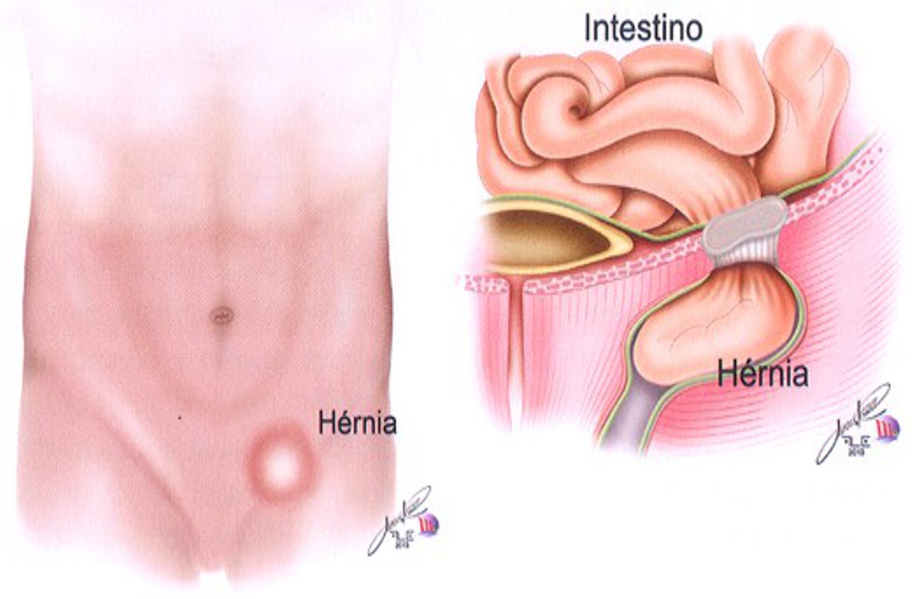 O que fazer no pós-operatório da hérnia inguinal - Hernia Clinic